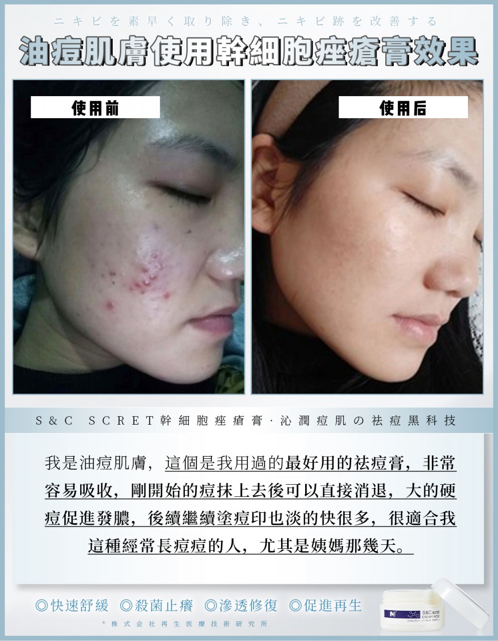 20g送爆水膜2.0一盒／3g送爆水膜2.0一片 幹細胞痤瘡膏